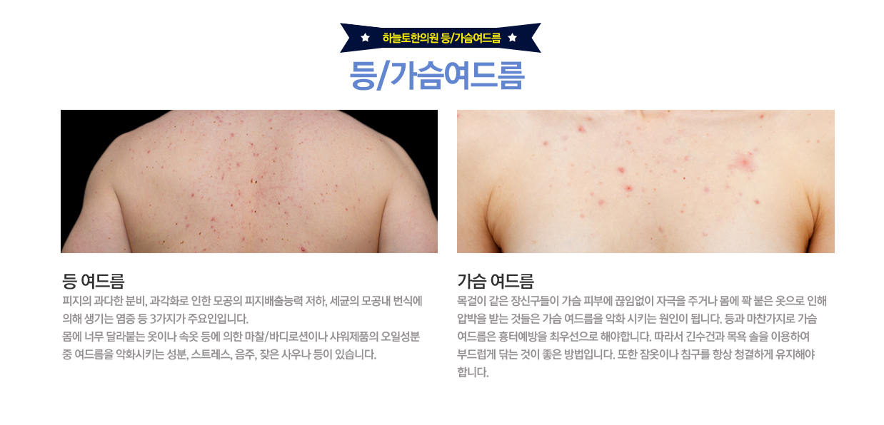 등여드름